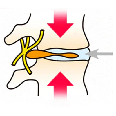 spinal disc treatment solution heal lower back herniated bulging disc