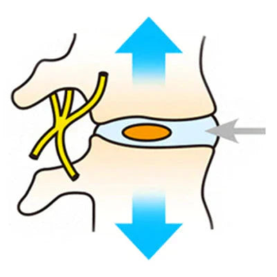 spinal disc treatment solution heal lower back herniated bulging disc